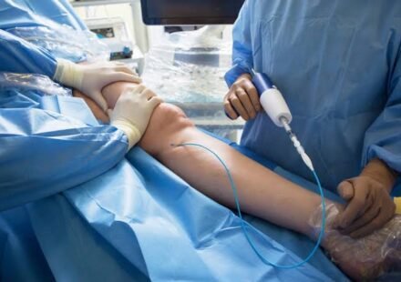 Glue Treatment Of Varicose Veins