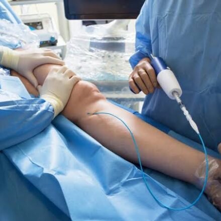 Glue Treatment Of Varicose Veins