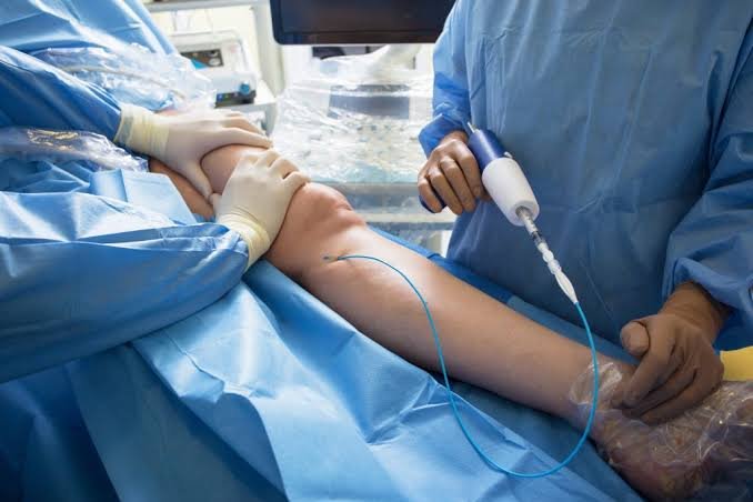 Glue Treatment Of Varicose Veins